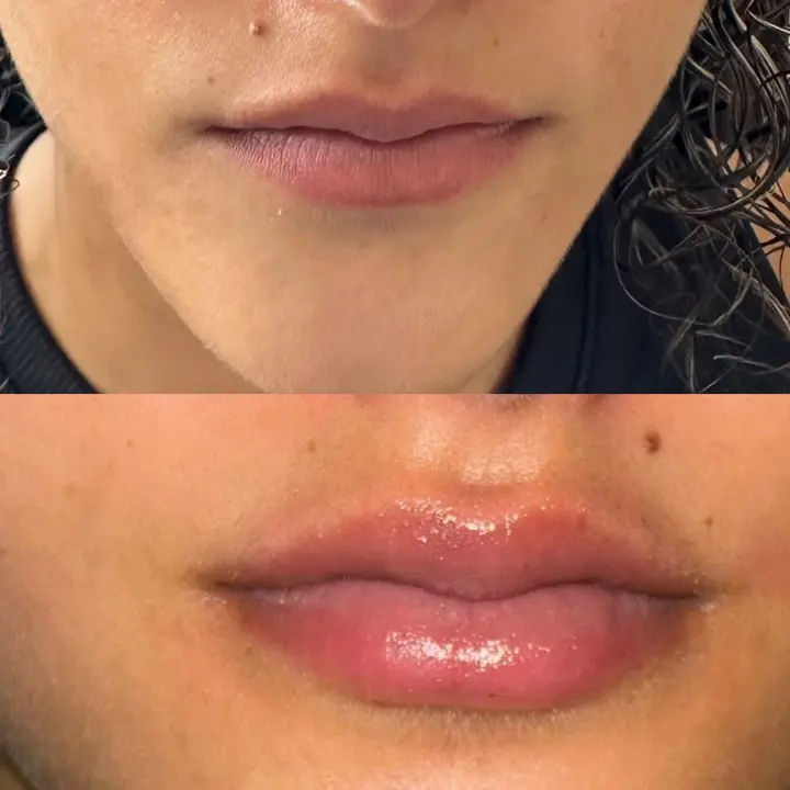 AnyConv.com__botox-2