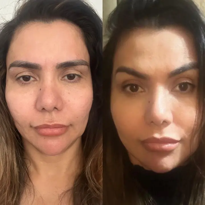 AnyConv.com__botox-4