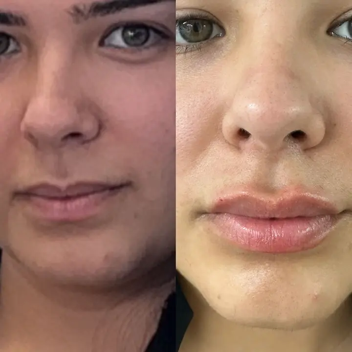 AnyConv.com__botox-5
