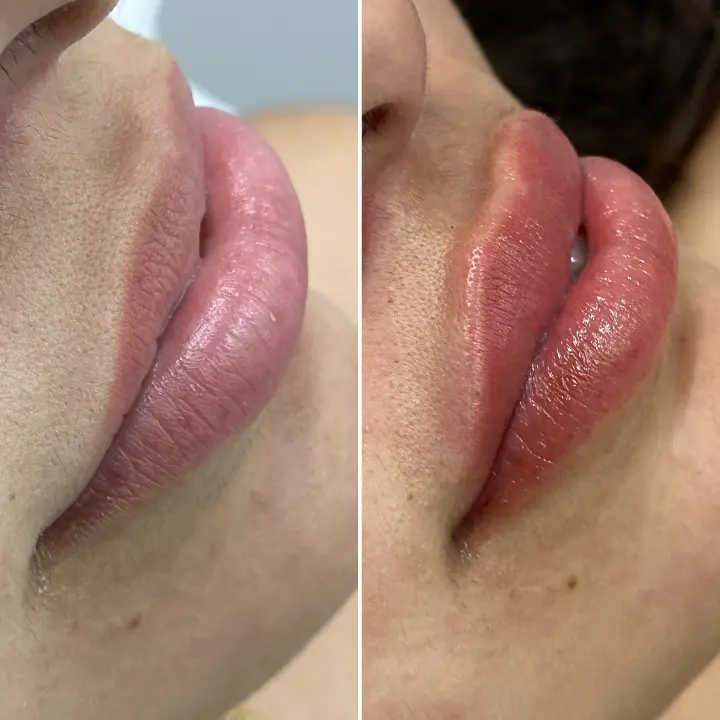 AnyConv.com__botox-6